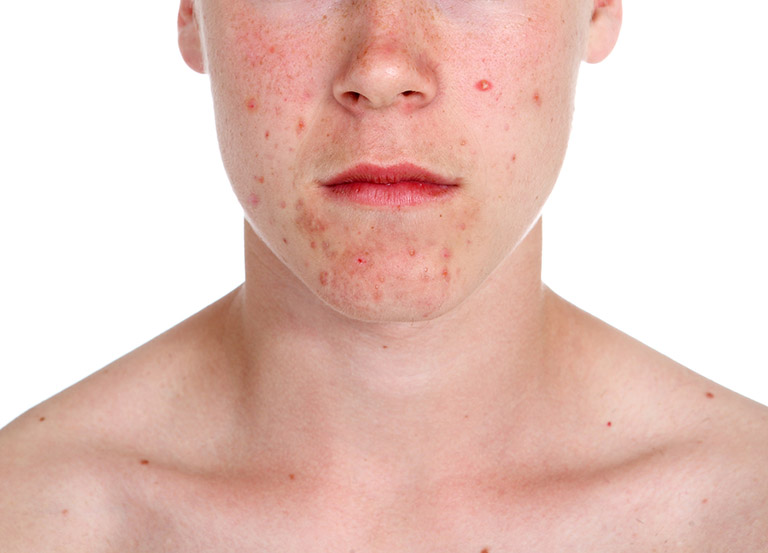 Dị ứng da mặt và nguyên nhân 